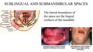 SUBLINGUAL AND SUBMANDIBULAR SPACES
The lateral boundaries of
the space are the lingual
surfaces of the mandible
 