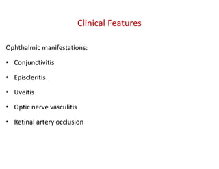 Clinical Features
Ophthalmic manifestations:
• Conjunctivitis
• Episcleritis
• Uveitis
• Optic nerve vasculitis
• Retinal artery occlusion
 