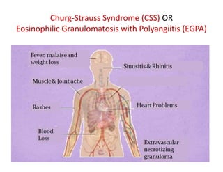 Churg-Strauss Syndrome (CSS) OR
Eosinophilic Granulomatosis with Polyangiitis (EGPA)
 