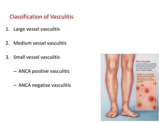 1. Large vessel vasculitis
2. Medium vessel vasculitis
3. Small vessel vasculitis
– ANCA positive vasculitis
– ANCA negative vasculitis
Classification of Vasculitis
 