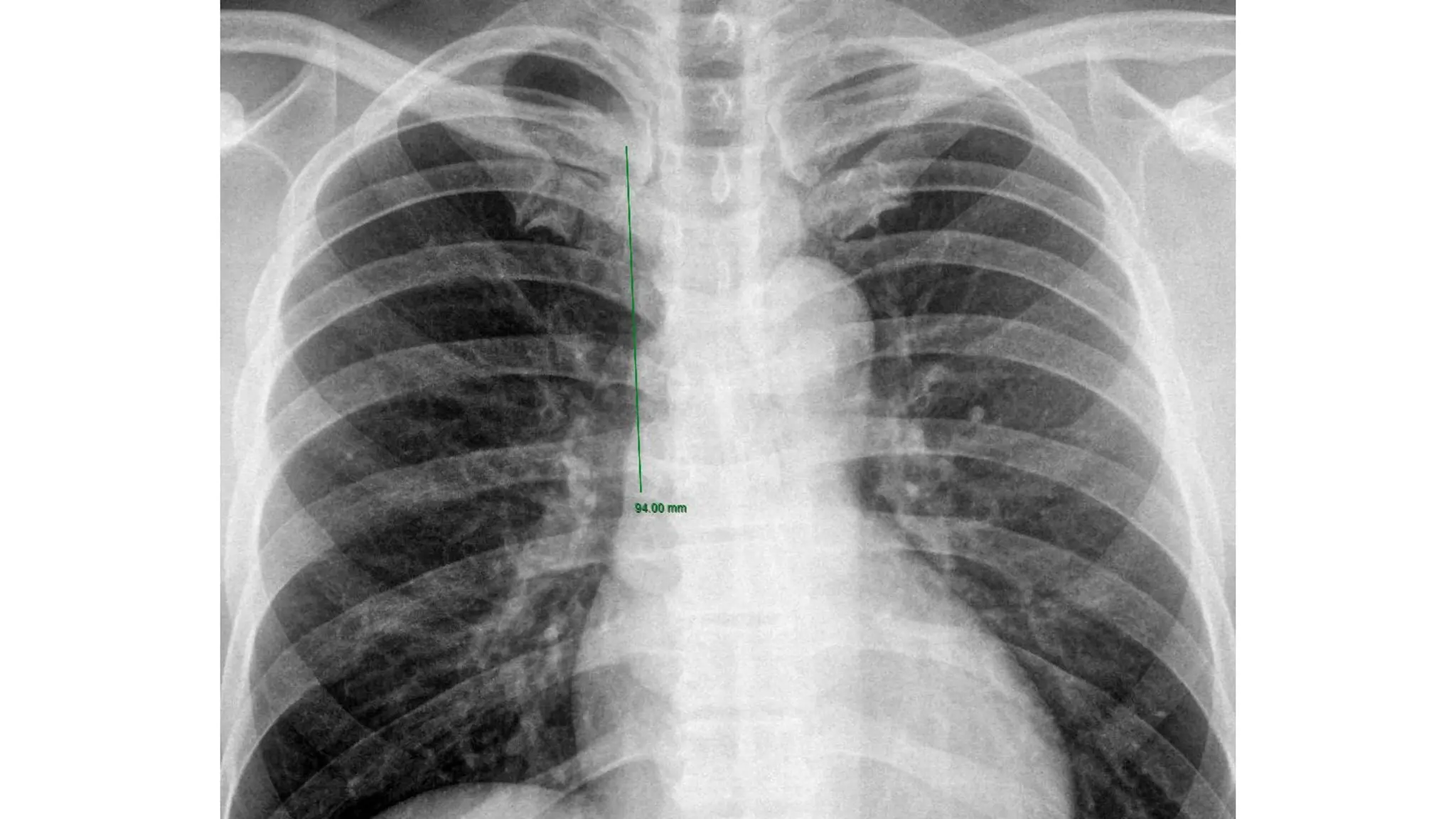 CHỌN MỐC CỐ ĐỊNH CATHETER
 