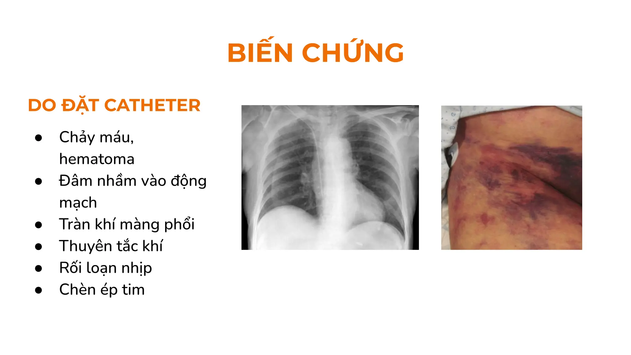 DO ĐẶT CATHETER
● Chảy máu,
hematoma
● Đâm nhầm vào động
mạch
● Tràn khí màng phổi
● Thuyên tắc khí
● Rối loạn nhịp
● Chèn ép tim
BIẾN CHỨNG
 