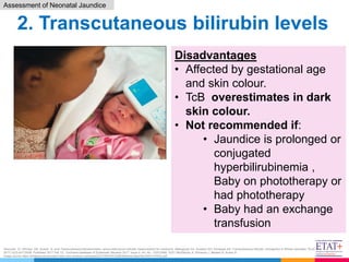 Tcb Graph Paediatrics. Neonatal Jaundice - April 2021.pdf