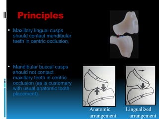 10. Occlusion and it's types in complete dentures | PDF