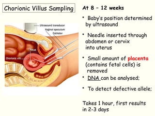 Chorionic Villus Sampling At 8 – 12 weeks
• Baby’s position determined
by ultrasound
• Needle inserted through
abdomen or cervix
into uterus
• Small amount of placenta
(contains fetal cells) is
removed
• DNA can be analysed;
• To detect defective allele;
Takes 1 hour, first results
in 2-3 days
 