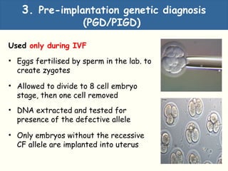 3. Pre-implantation genetic diagnosis
(PGD/PIGD)
Used only during IVF
• Eggs fertilised by sperm in the lab. to
create zygotes
• Allowed to divide to 8 cell embryo
stage, then one cell removed
• DNA extracted and tested for
presence of the defective allele
• Only embryos without the recessive
CF allele are implanted into uterus
 