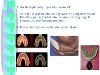 3. Mix the light body impression material:
• Part of it is loaded into the tray over the putty impression
• The other part is loaded into the impression syringe &
injected around the prepared tooth
4. Take an impression for the whole dental arch
 