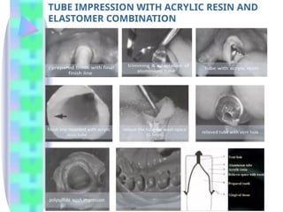 TUBE IMPRESSION WITH ACRYLIC RESIN AND
ELASTOMER COMBINATION
 