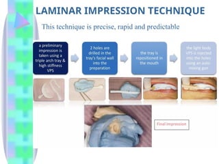 LAMINAR IMPRESSION TECHNIQUE
This technique is precise, rapid and predictable
 
