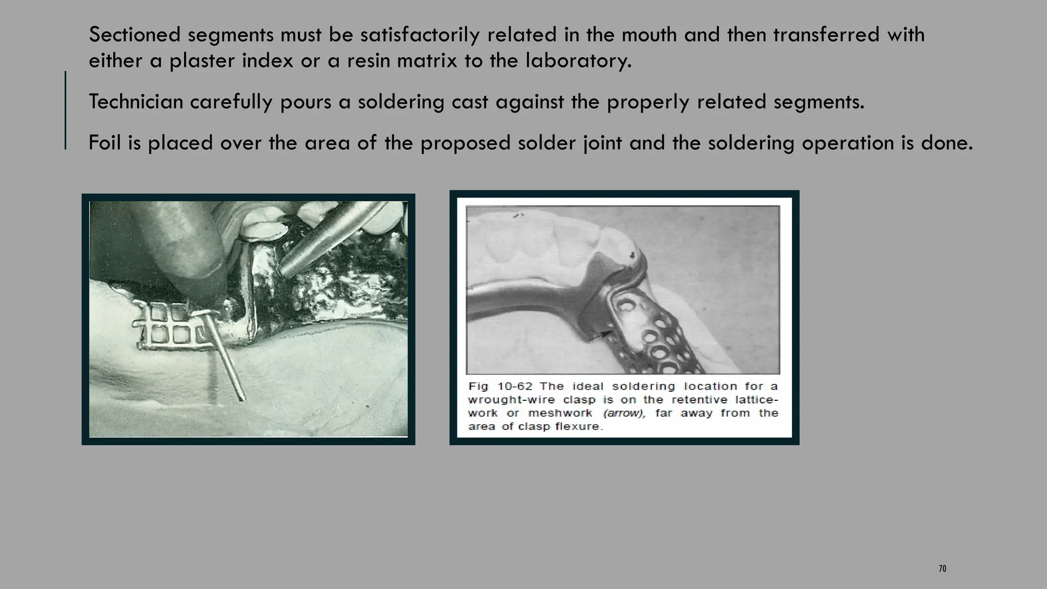 70
Sectioned segments must be satisfactorily related in the mouth and then transferred with
either a plaster index or a resin matrix to the laboratory.
Technician carefully pours a soldering cast against the properly related segments.
Foil is placed over the area of the proposed solder joint and the soldering operation is done.
 