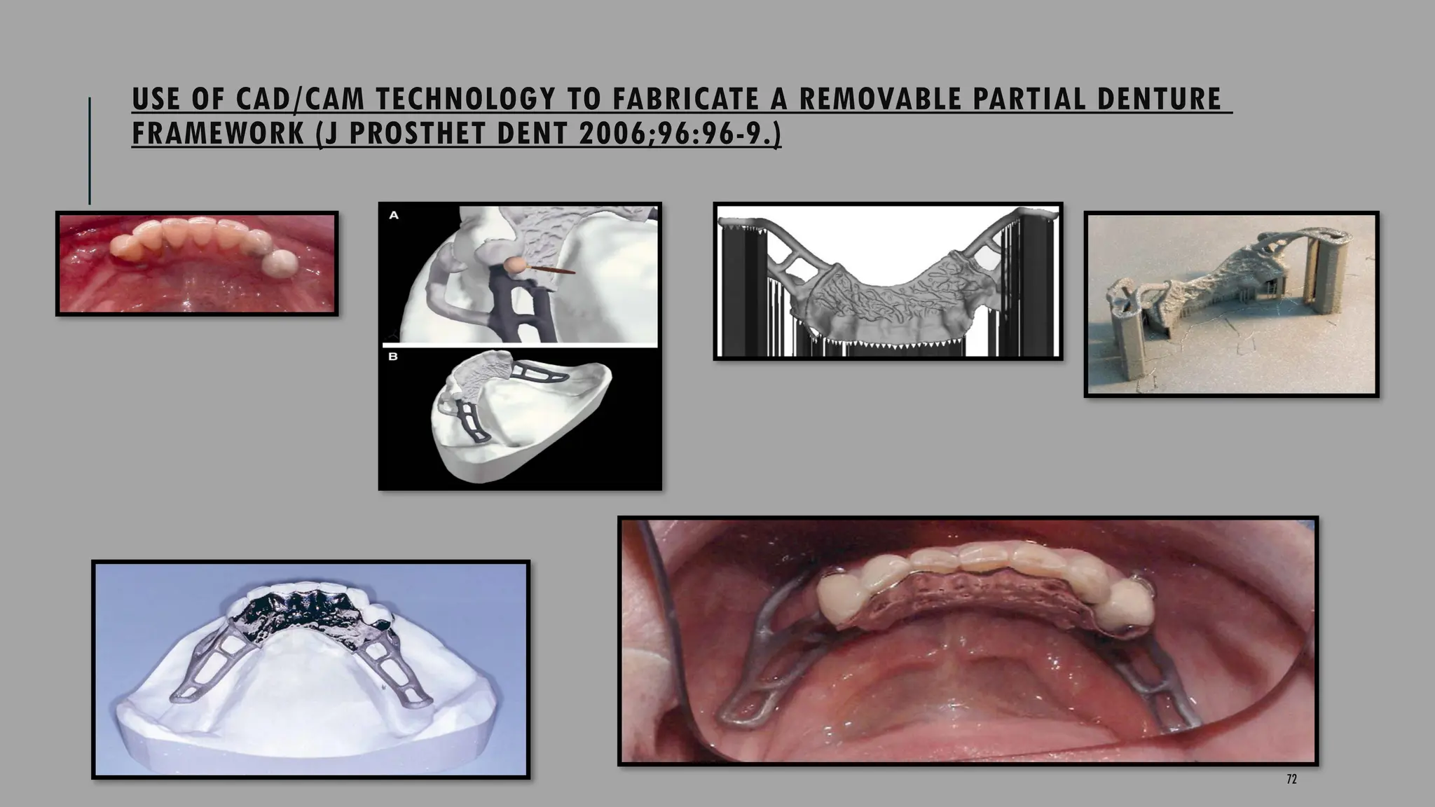 72
USE OF CAD/CAM TECHNOLOGY TO FABRICATE A REMOVABLE PARTIAL DENTURE
FRAMEWORK (J PROSTHET DENT 2006;96:96-9.)
 