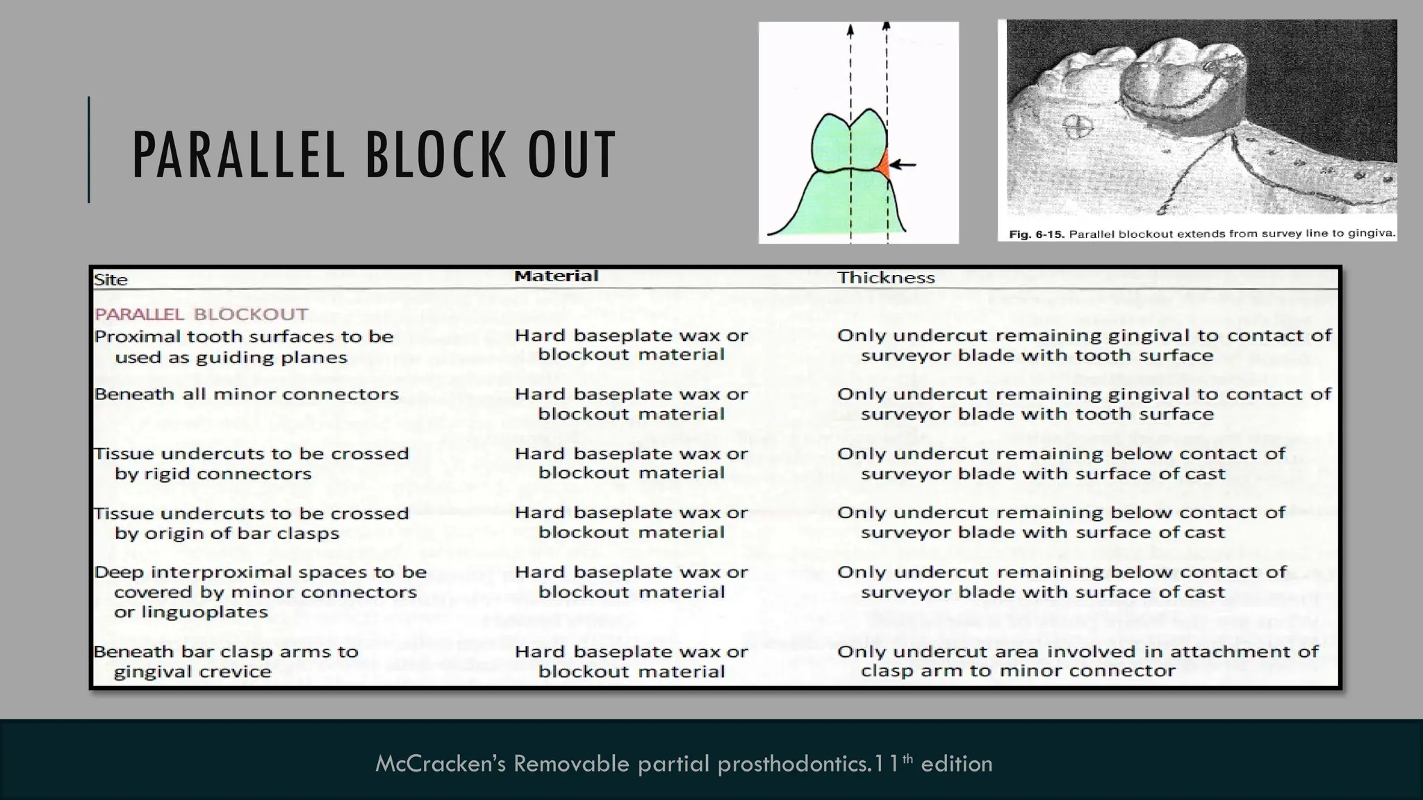 9
PARALLEL BLOCK OUT
McCracken’s Removable partial prosthodontics.11th
edition
 