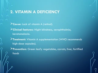 2. VITAMIN A DEFICIENCY
Cause: Lack of vitamin A (retinol).
Clinical features: Night blindness, xerophthalmia,
keratomalacia.
Treatment: Vitamin A supplementation (WHO recommends
high-dose capsules).
Prevention: Green leafy vegetables, carrots, liver, fortified
foods
 
