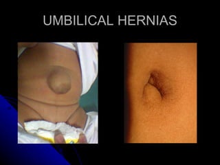 10 Abdominal Wall Defects Dr Fidel | PPT