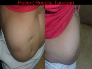 Patient Rogelia Tacuban 