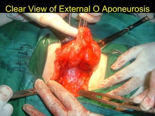 Clear View of External O Aponeurosis 