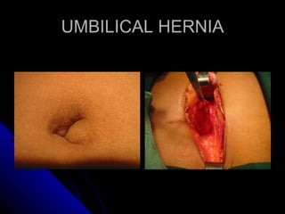 UMBILICAL HERNIA 