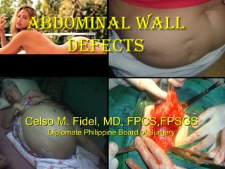 ABDOMINAL WALL DEFECTS Celso M. Fidel, MD, FPCS,FPSGS Diplomate Philippine Board of Surgery 