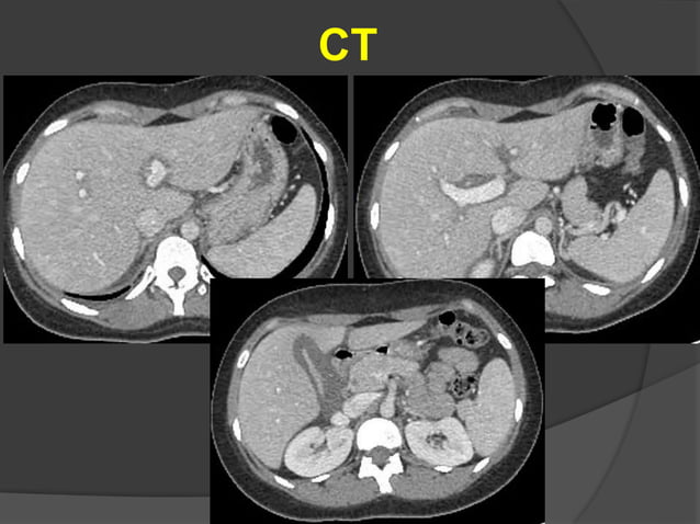 10 Acute Abdomen 1 Ppt