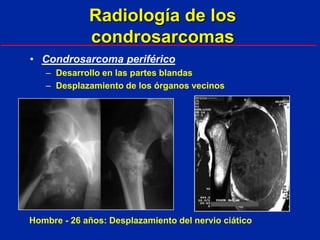 10 condrosarcomas | PPT