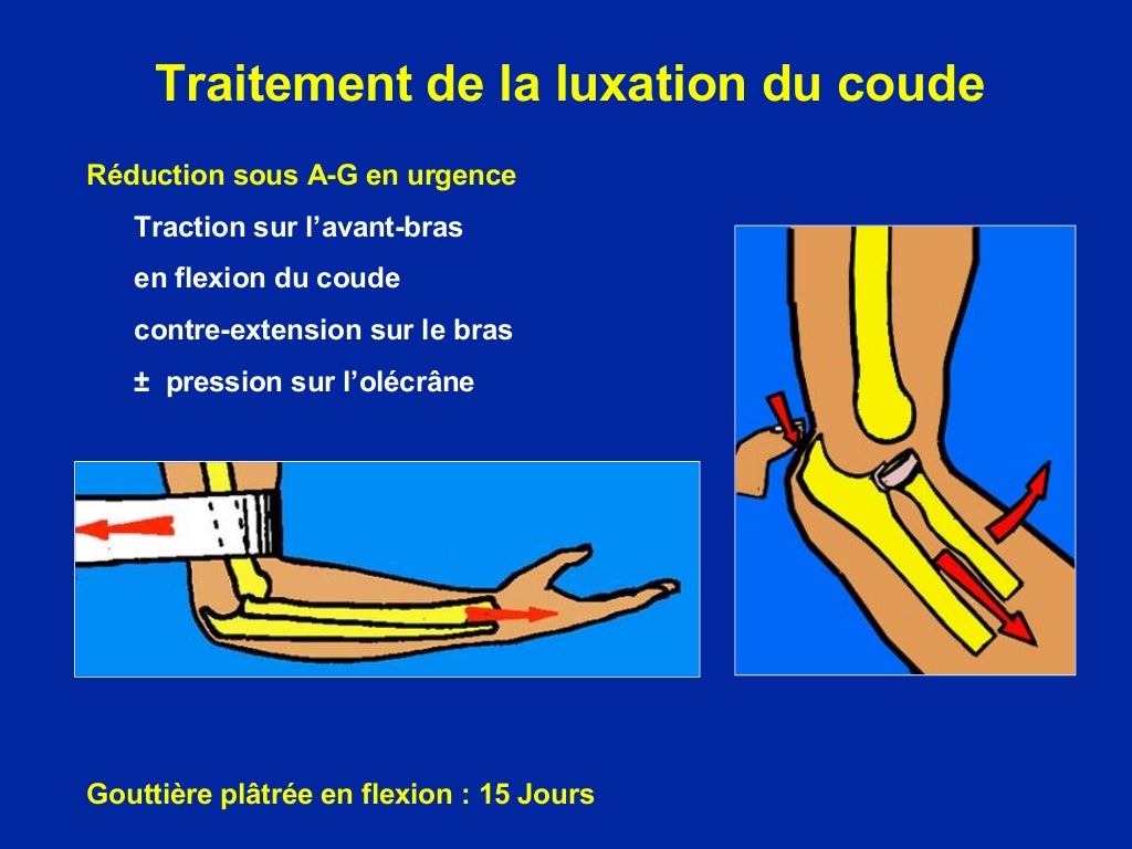 Luxations du coude