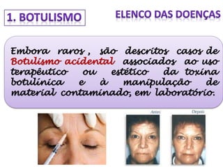 Embora raros , são descritos casos de
Botulismo acidental associados ao uso
terapêutico ou estético da toxina
botulínica e à manipulação de
material contaminado, em laboratório.
 