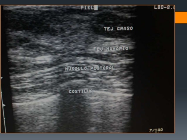 Ecografia Mamaria Dexeus Mujer