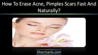 How To Erase Acne, Pimples Scars Fast And
Naturally?

Dharmanis.com

 