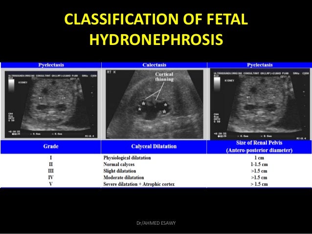 10 Fetal Urinary Tract Dr Ahmed Esawy 10-fetal-urinary-tract-dr-ahmed-esawy