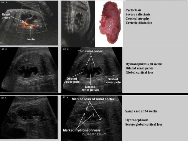 Kidney Dilation 20 Week Scan Kidney Failure Disease