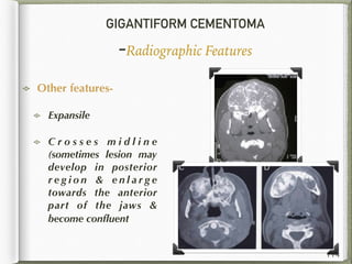 GIGANTIFORM CEMENTOMA
-Radiographic Features
Other features-
Expansile
C r o s s e s m i d l i n e
(sometimes lesion may
develop in posterior
r e g i o n & e n l a r g e
towards the anterior
part of the jaws &
become conﬂuent
114
 