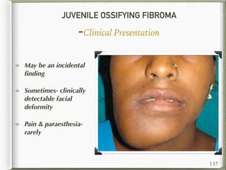 JUVENILE OSSIFYING FIBROMA
-Clinical Presentation
May be an incidental
ﬁnding
Sometimes- clinically
detectable facial
deformity
Pain & paraesthesia-
rarely
137
 