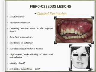 FIBRO-OSSEOUS LESIONS
-Clinical Evaluation
150
Facial deformity
Vestibular obliteration
Overlying mucosa- same as the adjacent
tissues
Bony-hard in consistency
Non-tender on palpation
May show ulceration due to trauma
Displacement, malpositioning of teeth with
malocclusion
Mobility of teeth
H/o pain or paraesthesia— rarely
 