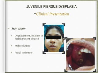 JUVENILE FIBROUS DYSPLASIA
-Clinical Presentation
May cause-
Displacement, rotation or
malalignment of teeth
Malocclusion
Facial deformity
29
 