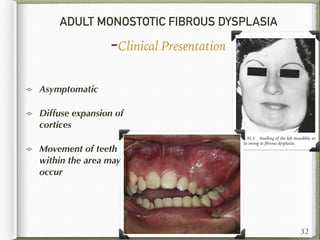 ADULT MONOSTOTIC FIBROUS DYSPLASIA
-Clinical Presentation
Asymptomatic
Diffuse expansion of
cortices
Movement of teeth
within the area may
occur
32
 