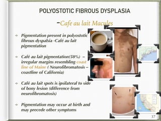 POLYOSTOTIC FIBROUS DYSPLASIA
-Cafe au lait Macules
Pigmentation present in polyostotic
ﬁbrous dyspalsia -Café au lait
pigmentation
Café au lait pigmentation(50%) –
irregular margins resembling coast
line of Maine ( Neuroﬁbromatosis –
coastline of California)
Café au lait spots is ipsilateral to side
of bony lesion (difference from
neuroﬁbromatosis)
Pigmentation may occur at birth and
may precede other symptoms
37
 