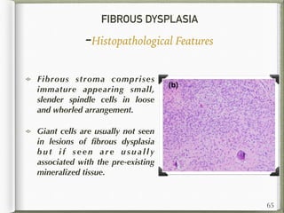 FIBROUS DYSPLASIA
-Histopathological Features
Fibrous stroma comprises
immature appearing small,
slender spindle cells in loose
and whorled arrangement.
Giant cells are usually not seen
in lesions of ﬁbrous dysplasia
b u t i f s e e n a r e u s u a l l y
associated with the pre-existing
mineralized tissue.
65
 