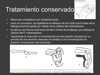 Tratamiento conservador
 Reducción ortopédica (con anestesia local) :
 mano en pronación, se hiperflecta el meñique de tal modo que la base de la
falange proximal quede por debajo de la cabeza del metacarpiano,
 se ejerce una fuerza axial hacia dorsal a través de la falange que empuja la
cabeza del 5° metacarpiano,
 lográndose la reducción e inmovilizando en esa posición forzada por un
período de una semana; después se cambia a una inmovilización en
posición funcional por dos semanas.
 
