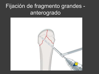 Fijación de fragmento grandes -
anterogrado
 