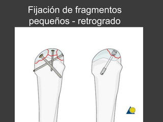 Fijación de fragmentos
pequeños - retrogrado
 