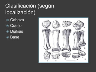 Clasificación (según
localización)
 Cabeza
 Cuello
 Diafisis
 Base
 