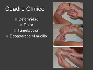 Cuadro Clínico
 Deformidad
 Dolor
 Tumefaccion
 Desaparece el nudillo
 