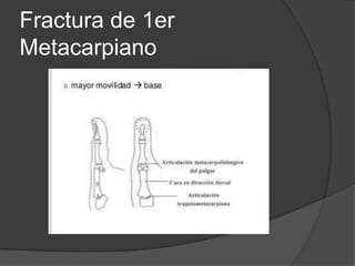 Fractura de 1er
Metacarpiano
 