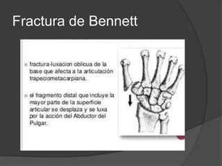 Fractura de Bennett
 
