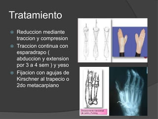 Tratamiento
 Reduccion mediante
traccion y compresion
 Traccion continua con
esparadrapo (
abduccion y extension
por 3 a 4 sem ) y yeso
 Fijacion con agujas de
Kirschner al trapecio o
2do metacarpiano
 