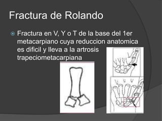 Fractura de Rolando
 Fractura en V, Y o T de la base del 1er
metacarpiano cuya reduccion anatomica
es dificil y lleva a la artrosis
trapeciometacarpiana
 