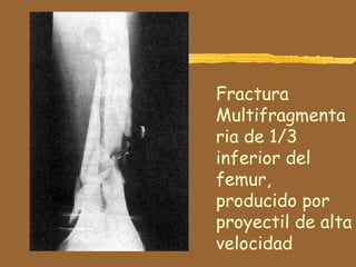 Fractura
Multifragmenta
ria de 1/3
inferior del
femur,
producido por
proyectil de alta
velocidad.
 