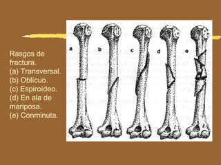 Rasgos de
fractura.
(a) Transversal.
(b) Oblícuo.
(c) Espiroídeo.
(d) En ala de
mariposa.
(e) Conminuta.
 