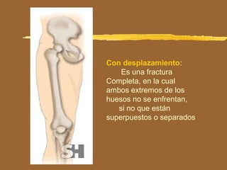 Con desplazamiento:
Es una fractura
Completa, en la cual
ambos extremos de los
huesos no se enfrentan,
si no que están
superpuestos o separados
 