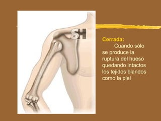 Cerrada:
Cuando sólo
se produce la
ruptura del hueso
quedando intactos
los tejidos blandos
como la piel
 